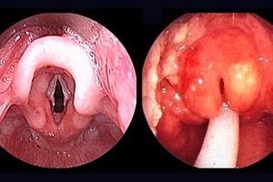 epiglottit.jpg